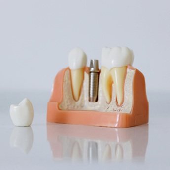 Dental Implant