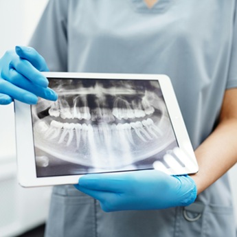 Root Canal Procedure
